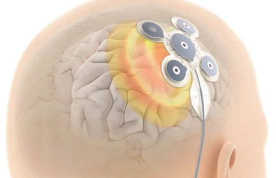 Analyse des réseaux cérébraux chez les patients par stimulation du cortex focal